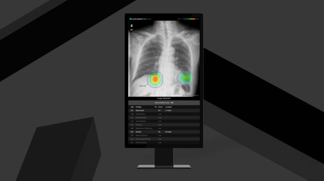 루닛 흉부 엑스레이 AI 영상분석 솔루션 '루닛 인사이트 CXR'. /루닛