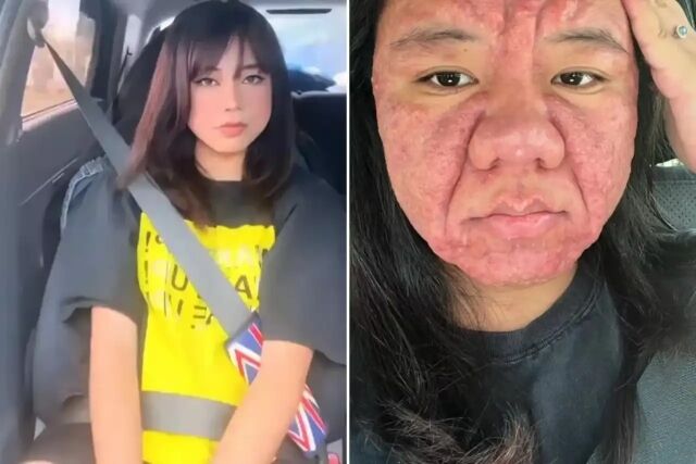 이게 같은 사람?임신으로 인해 얼굴이 완전히 변해버린 여성. 임신 코 중독이라고 한다./소셜미디어