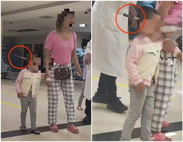 머리에 칼이 꽂힌 채 걸어들어와 수술받은 3살여아./중국 소셜미디어