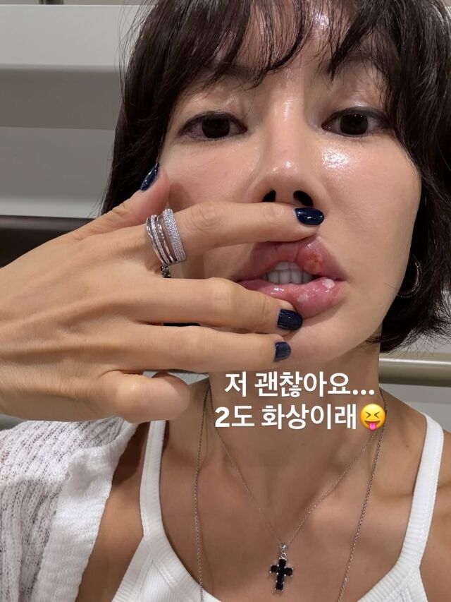 배우 양미라가 입술 화상을 입은 근황을 전했다. / 양미라 인스타그램