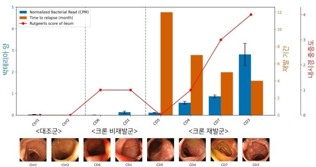크론병 환자의 장 조직을 분석한 결과, 크론병 장 조직에서 염증이 심한 부위에서 미생물의 분포가 크게 증가하는 것으로 나타났으며, 미생물의 분포 정도가 클수록 재발 기간이 짧고, 중증도가 큰 것으로 확인됐다. /연세대 의대