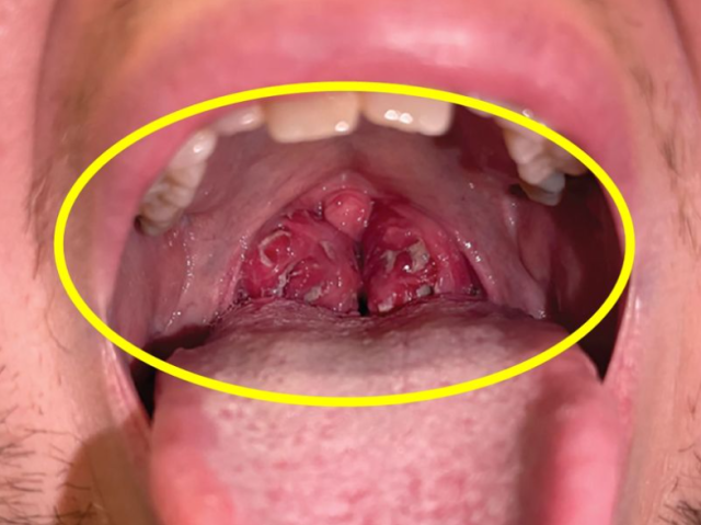 일병 '키스병'이라 불리는 감염성 단핵구증을 진단받은 남성의 편도. /클리블랜드 클리닉 의학 저널 캡처