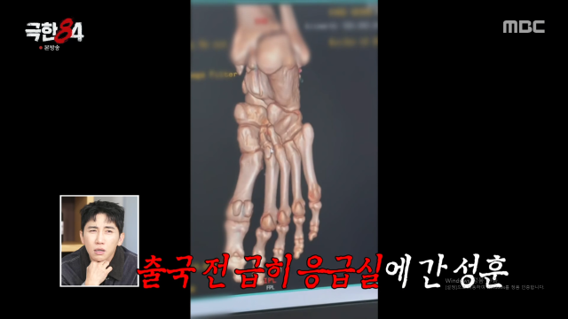 秋成勋因两处骨折，仅出演一集便将退出节目……Kian84成为首位离开《极限84》的工作人员。