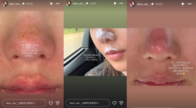 가수 권은비가 아프리카 최고봉 킬리만자로 등반의 훈장(?)으로 입은 심각한 피부 부상을 공개해 팬들을 놀라게 했다./권은비 소셜미디어