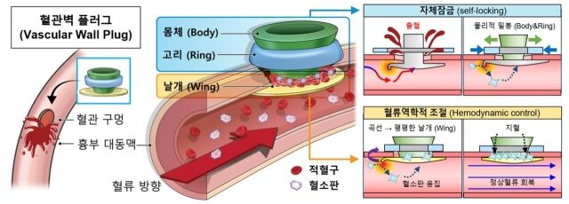 연구팀이 개발한 혈관벽플러그 개요. /세브란스병원
