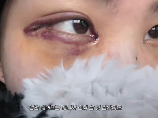 최준희가 수술 후 부기가 빠져가는 모습을 영상으로 남겼다. / 유튜브 '준희 JUNEHEE'
