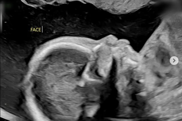 임신 22주차 배우 남보라가 태명 콩알이 초정밀 초음파 사진을 공개했다./남보라 소셜미디어