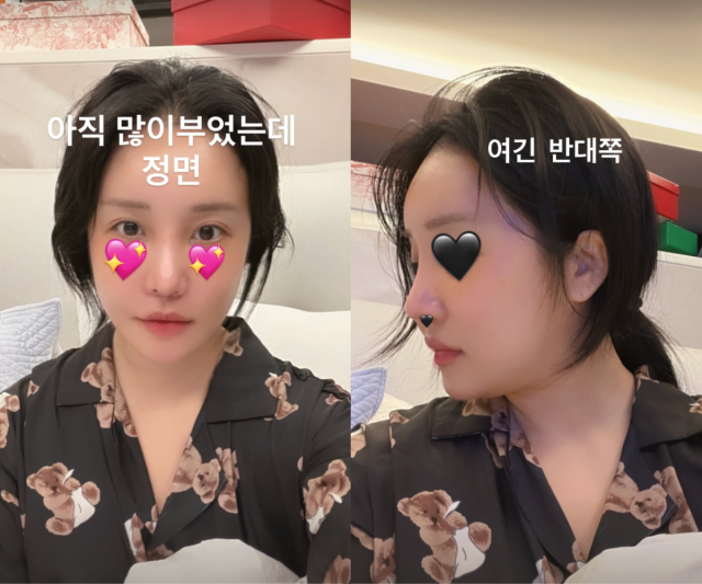랄랄이 성형 수술 이후 달라진 근황을 전했다. / 랄랄 SNS