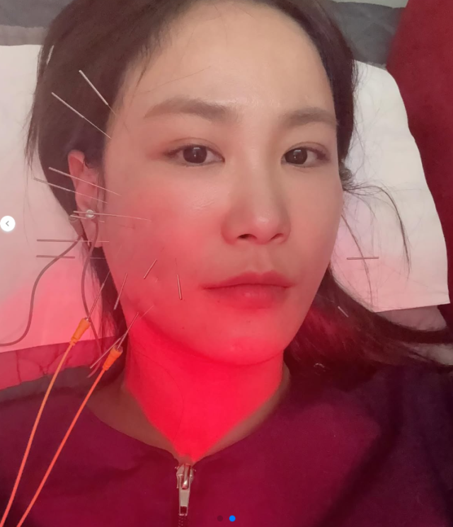 낙상 사고로 볼이 함몰돼 침 치료를 받고 있는 개그우먼 김지민./김지민 소셜미디어