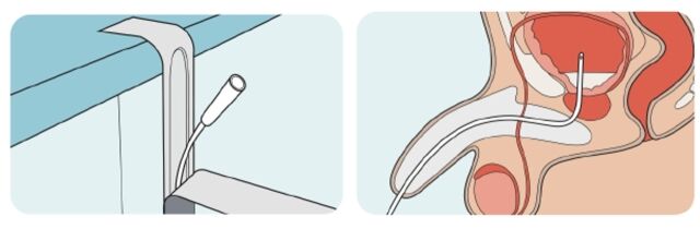 신경인성 방광 환자가 일회용 카테터를 방광에 삽입해 방광을 비우는 ‘청결 간헐적 도뇨법’. /서울아산병원