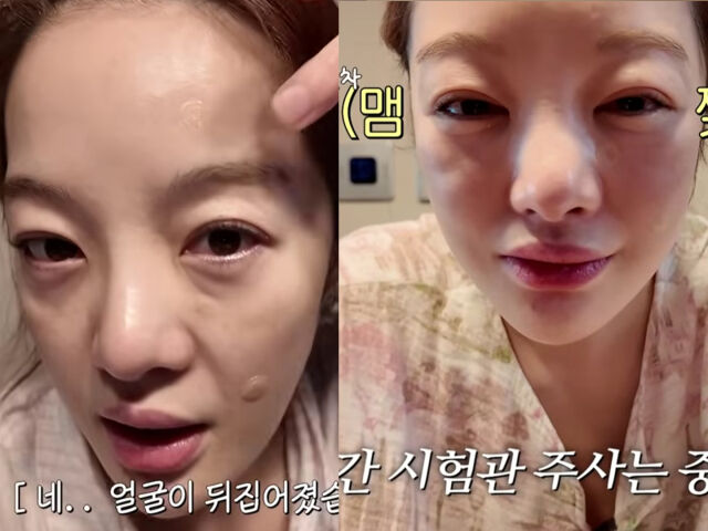 황보라가 시험관 주사를 맞고 얼굴이 뒤집어졌으며 온몸이 퉁퉁 부었다고 말했다. / 유튜브 '황보라 보라이어티'