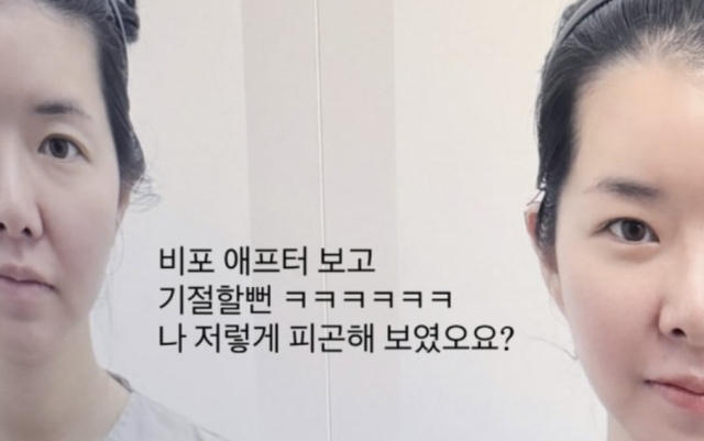 김지혜는 지난 23일 SNS를 통해 “눈밑지 한 달 다 돼가서 경과 보러 왔다”라는 글과 함께 네이비 컬러의 상의를 입고 환하게 미소 짓는 셀카 사진을 공개했다./김지혜 소셜미디어