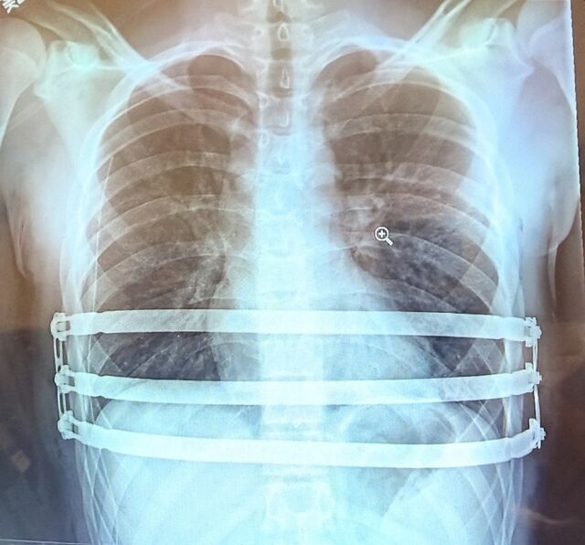 자로주스키 박사가 팩투스 수술을 집도 한 후 촬영한 흉부 X-ray 영상 이미지. /엘앤케이바이오메드