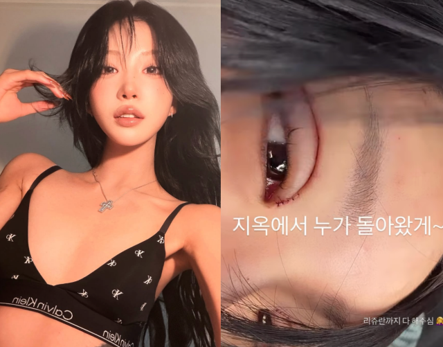 최진실의 딸이자 인플루언서 최준희가 눈 성형수술 직후 모습을 공개했다. / 최준희 SNS
