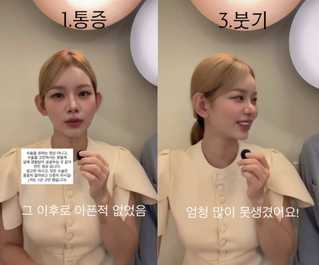 맹승지가 인중 축소 수술을 받은 지 약 두 달이 지난 가운데, 비용부터 통증과 부기까지 직접 겪은 후기를 공개했다. / 맹승지 SNS
