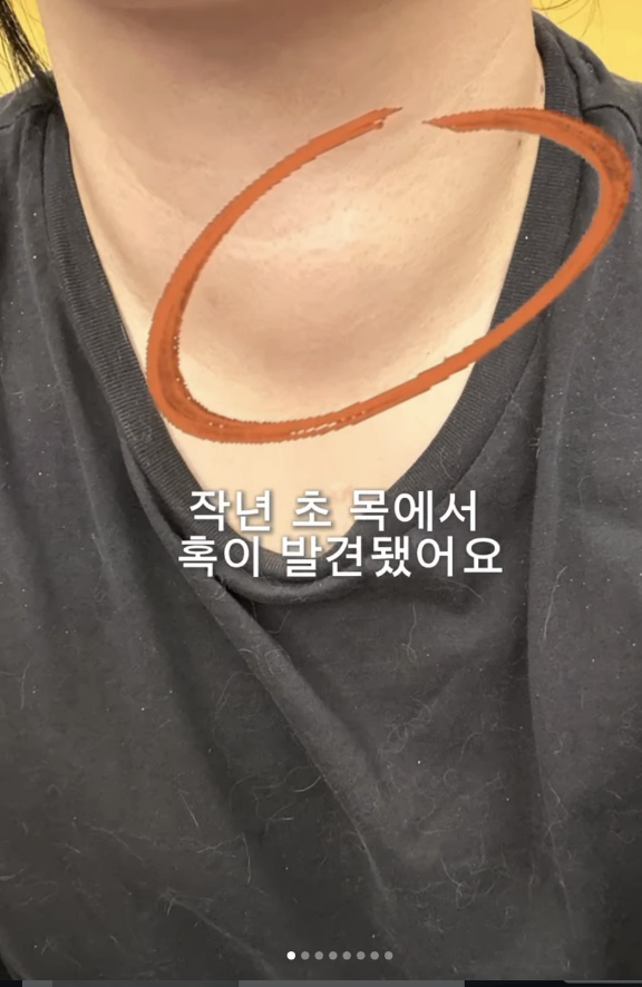 허안나가 갑상선 수술 이후 극심한 피로감에 시달리고 있다고 고백했다. / 허안나 SNS